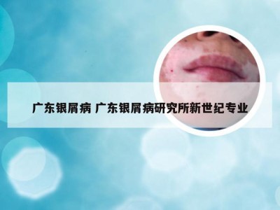 广东银屑病 广东银屑病研究所新世纪专业