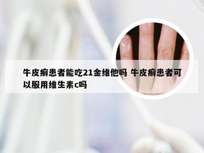 牛皮癣患者能吃21金维他吗 牛皮癣患者可以服用维生素c吗