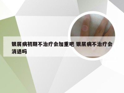 银屑病初期不治疗会加重吧 银屑病不治疗会消退吗