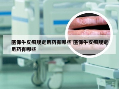 医保牛皮癣规定用药有哪些 医保牛皮癣规定用药有哪些