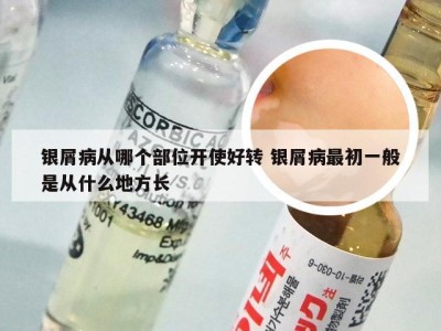 银屑病从哪个部位开使好转 银屑病最初一般是从什么地方长