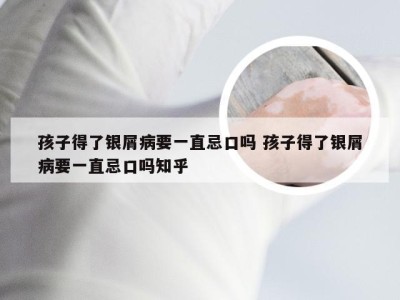 孩子得了银屑病要一直忌口吗 孩子得了银屑病要一直忌口吗知乎