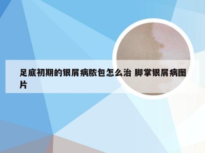 足底初期的银屑病脓包怎么治 脚掌银屑病图片