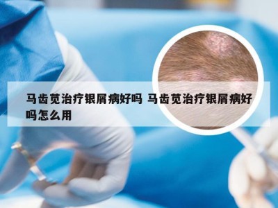 马齿苋治疗银屑病好吗 马齿苋治疗银屑病好吗怎么用