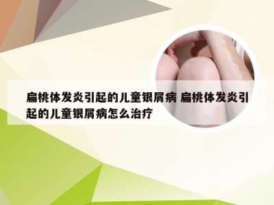 扁桃体发炎引起的儿童银屑病 扁桃体发炎引起的儿童银屑病怎么治疗
