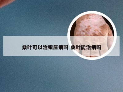 桑叶可以治银屑病吗 桑叶能治病吗