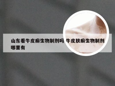 山东看牛皮癣生物制剂吗 牛皮肤癣生物制剂哪里有