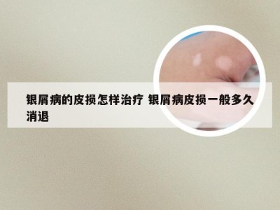 银屑病的皮损怎样治疗 银屑病皮损一般多久消退