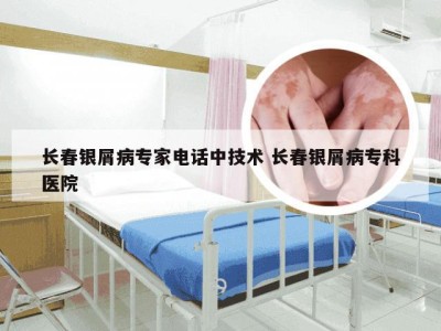 长春银屑病专家电话中技术 长春银屑病专科医院