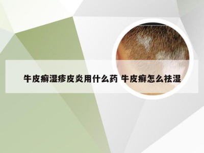 牛皮癣湿疹皮炎用什么药 牛皮癣怎么祛湿