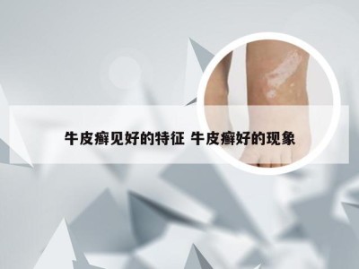牛皮癣见好的特征 牛皮癣好的现象