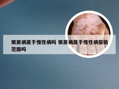 银屑病属于慢性病吗 银屑病属于慢性病报销范围吗