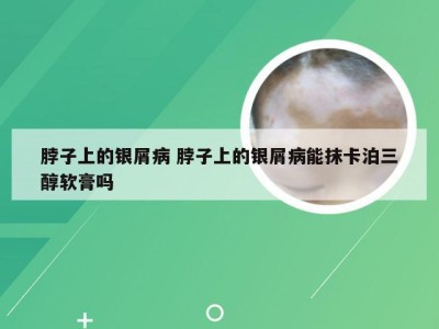 脖子上的银屑病 脖子上的银屑病能抹卡泊三醇软膏吗