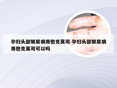 孕妇头部银屑病用他克莫司 孕妇头部银屑病用他克莫司可以吗