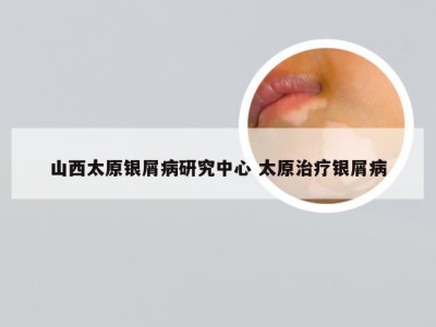 山西太原银屑病研究中心 太原治疗银屑病