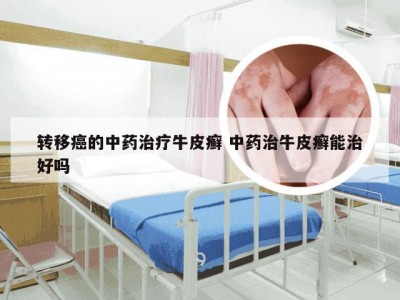转移癌的中药治疗牛皮癣 中药治牛皮癣能治好吗