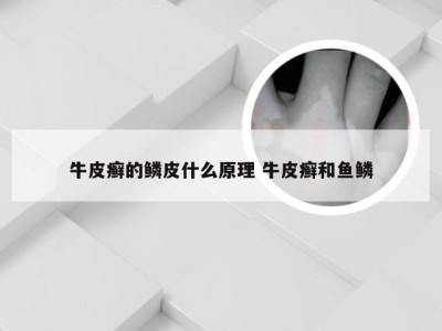 牛皮癣的鳞皮什么原理 牛皮癣和鱼鳞