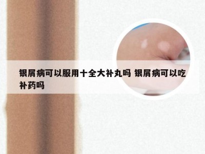 银屑病可以服用十全大补丸吗 银屑病可以吃补药吗