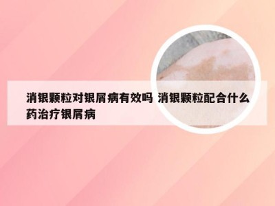 消银颗粒对银屑病有效吗 消银颗粒配合什么药治疗银屑病