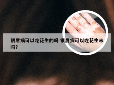 银屑病可以吃花生的吗 银屑病可以吃花生米吗?