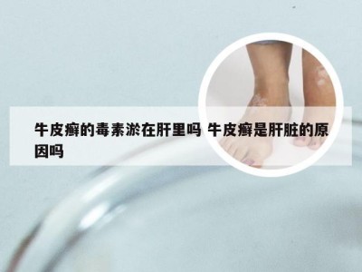 牛皮癣的毒素淤在肝里吗 牛皮癣是肝脏的原因吗
