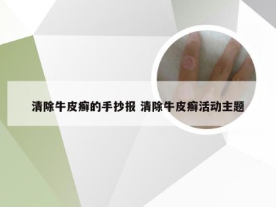 清除牛皮癣的手抄报 清除牛皮癣活动主题