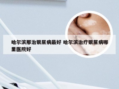 哈尔滨那治银屑病最好 哈尔滨治疗银屑病哪里医院好
