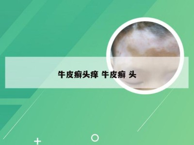 牛皮癣头痒 牛皮癣 头