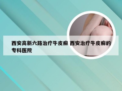 西安高新六路治疗牛皮癣 西安治疗牛皮癣的专科医院