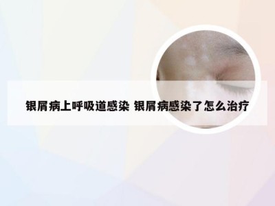 银屑病上呼吸道感染 银屑病感染了怎么治疗