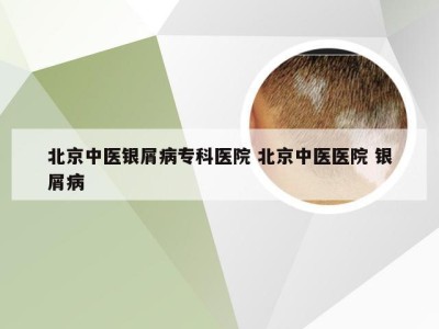 北京中医银屑病专科医院 北京中医医院 银屑病