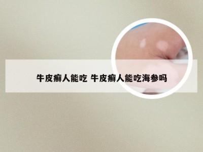 牛皮癣人能吃 牛皮癣人能吃海参吗