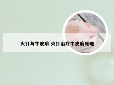 火针与牛皮癣 火针治疗牛皮癣原理