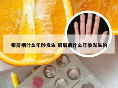 银屑病什么年龄发生 银屑病什么年龄发生的