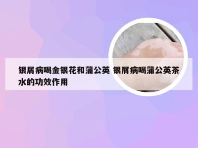 银屑病喝金银花和蒲公英 银屑病喝蒲公英茶水的功效作用