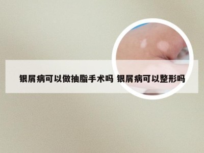银屑病可以做抽脂手术吗 银屑病可以整形吗