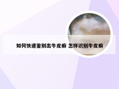 如何快速鉴别出牛皮癣 怎样识别牛皮癣