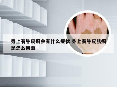 身上有牛皮癣会有什么症状 身上有牛皮肤癣是怎么回事