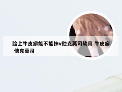 脸上牛皮癣能不能抹v他克莫司软膏 牛皮癣 他克莫司