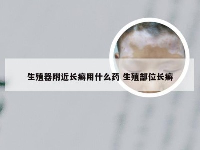 生殖器附近长癣用什么药 生殖部位长癣