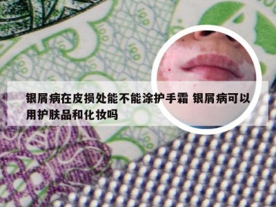 银屑病在皮损处能不能涂护手霜 银屑病可以用护肤品和化妆吗