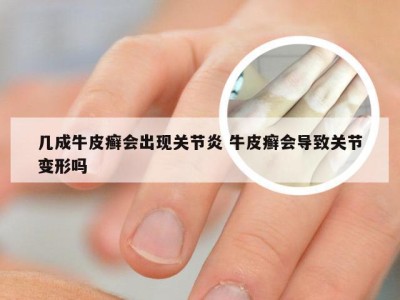 几成牛皮癣会出现关节炎 牛皮癣会导致关节变形吗