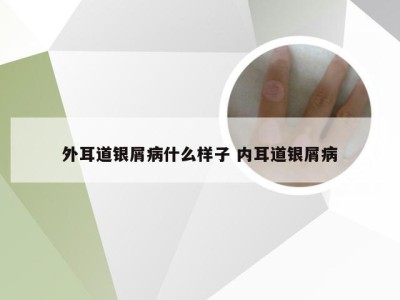 外耳道银屑病什么样子 内耳道银屑病