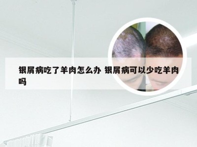 银屑病吃了羊肉怎么办 银屑病可以少吃羊肉吗