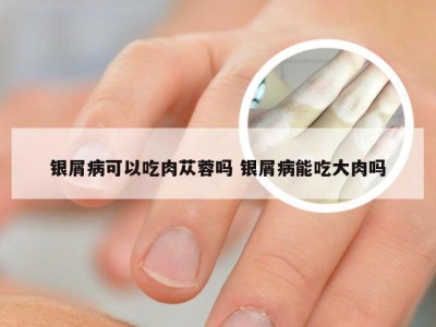 银屑病可以吃肉苁蓉吗 银屑病能吃大肉吗