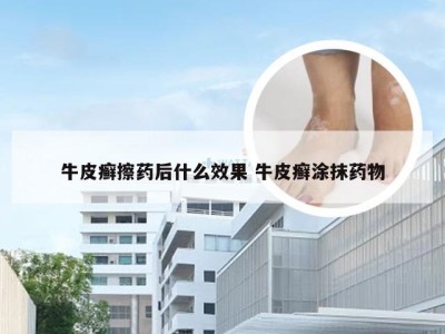 牛皮癣擦药后什么效果 牛皮癣涂抹药物