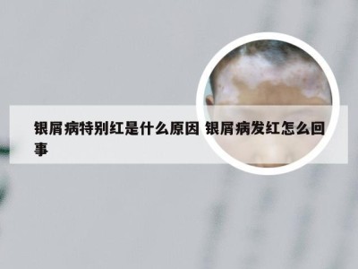 银屑病特别红是什么原因 银屑病发红怎么回事