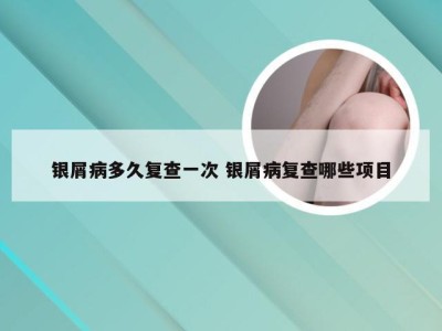银屑病多久复查一次 银屑病复查哪些项目