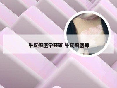 牛皮癣医学突破 牛皮癣医师