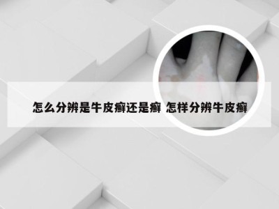 怎么分辨是牛皮癣还是癣 怎样分辨牛皮癣